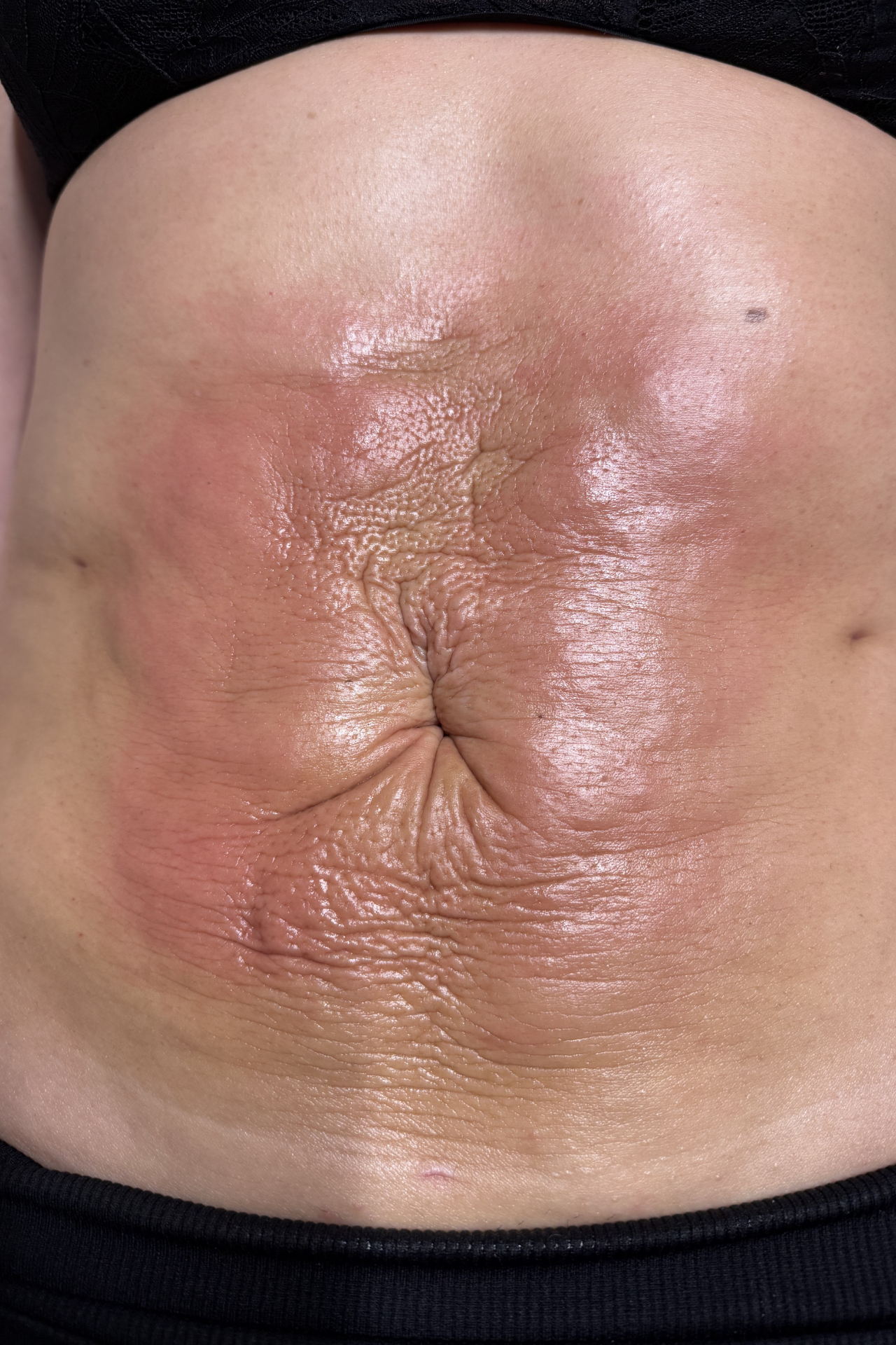 Klinische foto — Acute herstelfase