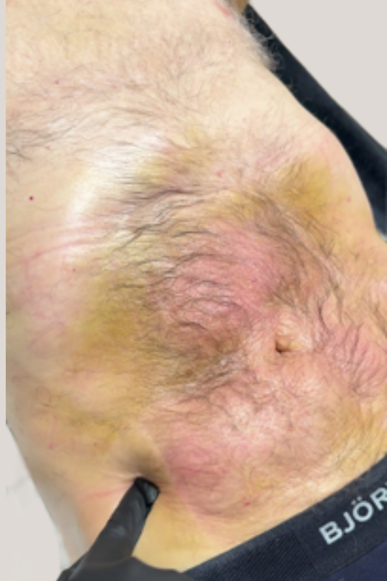 Klinische foto — Subacute herstelfase